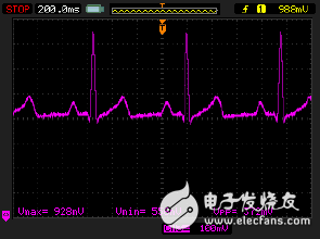 監(jiān)護(hù)儀模擬輸出端顯示出從電力線耦合而來(lái)的噪聲